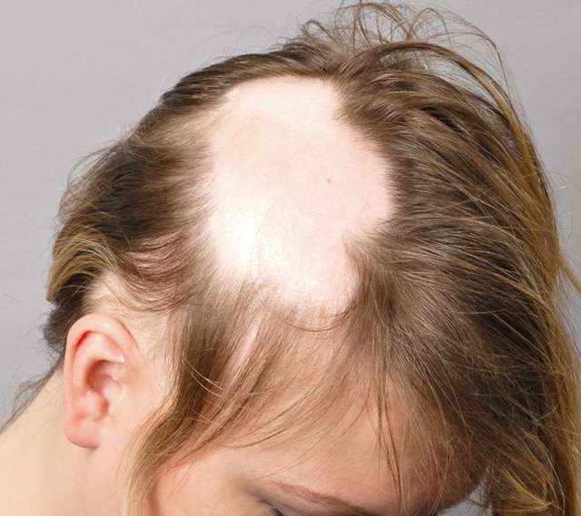 Alopecia. We must avoid it.