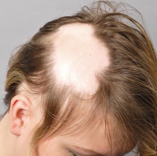 alopecia-areata-body.jpg