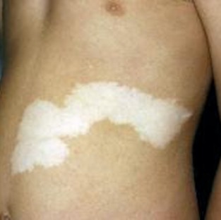 segmental-vitiligo.jpg