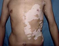 Segmental Vitiligo. We must avoid it.