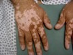 Vitiligo Acral. We must avoid it.
