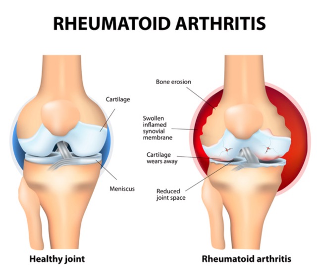 Rheumatism. We must avoid it.