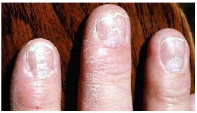 Nails conditions. We must avoid it.